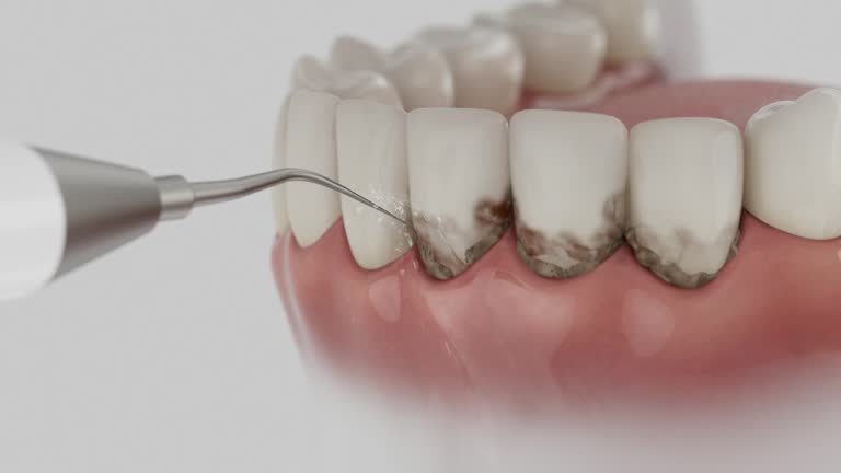 Trusted Wisdom Tooth Removal service in Edwardsville, PA - Dentist Open Now